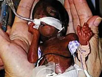 УНИКАЛНО! Бебе се роди едва 284 грама и оживя (СНИМКИ)