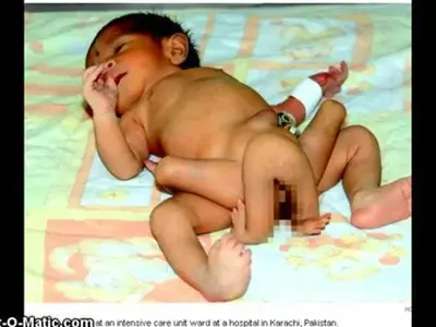 УНИКАЛНО! Дете се роди с шест крака (ВИДЕО)