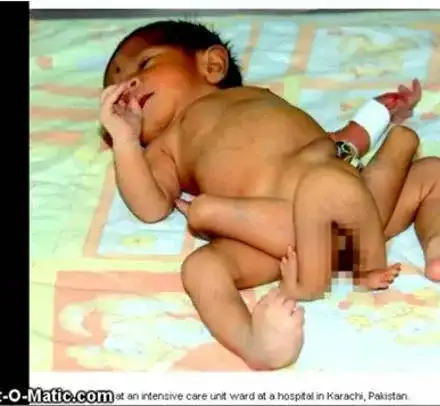 УНИКАЛНО! Дете се роди с шест крака (ВИДЕО)