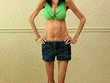 Кошмарно заболяване превърна тази жена в най-грозната в света (ВИЖТЕ КАК НЕ СЕ ПРЕДАВА+СНИМКИ)