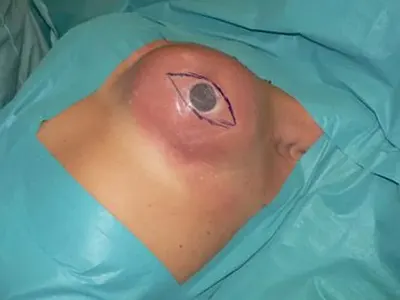 Комар спука силикони