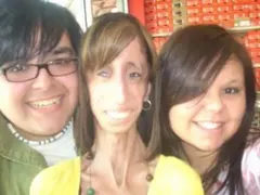 Кошмарно заболяване превърна тази жена в най-грозната в света (ВИЖТЕ КАК НЕ СЕ ПРЕДАВА+СНИМКИ)