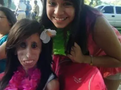 Кошмарно заболяване превърна тази жена в най-грозната в света (ВИЖТЕ КАК НЕ СЕ ПРЕДАВА+СНИМКИ)