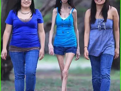 Кошмарно заболяване превърна тази жена в най-грозната в света (ВИЖТЕ КАК НЕ СЕ ПРЕДАВА+СНИМКИ)