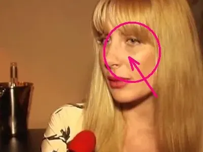 Какви са тези синини по лицето на Антония Петрова? (СНИМКИ)