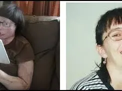 Вижте жената с присадено лице (СНИМКИ)