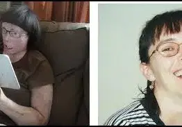 Вижте жената с присадено лице (СНИМКИ)