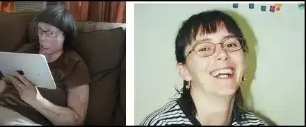 Вижте жената с присадено лице (СНИМКИ)