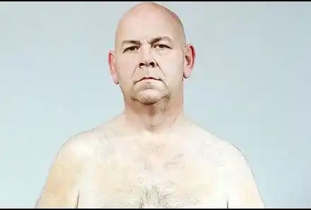 Отслабнал шишко се спъва в кожата си (СНИМКИ)