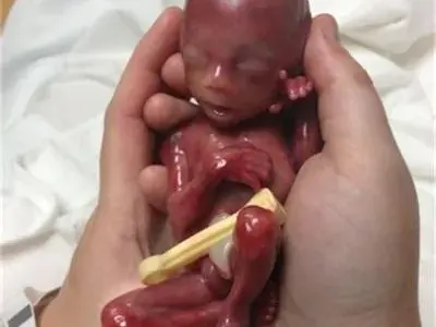 Тези СНИМКИ на бебе родено в 19-та седмица ТРОГНАХА МИЛИОНИ