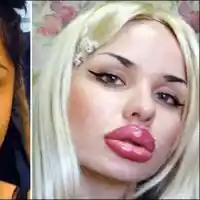 Вижте момичето с най-големите устни в света преди операциите