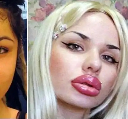 Вижте момичето с най-големите устни в света преди операциите