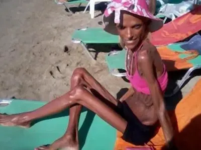 Красавица се превърна в скелет (Снимки)