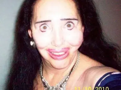 ТОП 5 на най-НЕСПОЛУЧЛИВИТЕ пластични операции! (ПОТРЕСАВАЩИ СНИМКИ)