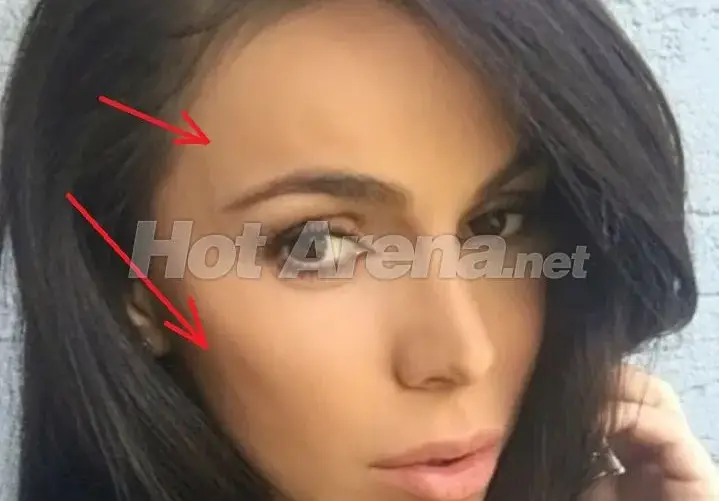 Алисия бори пачи крак с ударни количества ботокс! Получава ли й се? (Цялото й лице е на буци - СНИМКИ)