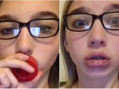 Не е за слаби нерви! Девойки се обезобразяват заради Кайли Дженър (Новата мания побърка нета)