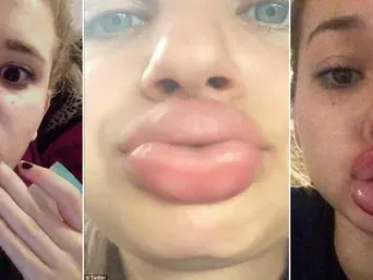 Не е за слаби нерви! Девойки се обезобразяват заради Кайли Дженър (Новата мания побърка нета)