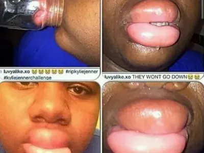 Не е за слаби нерви! Девойки се обезобразяват заради Кайли Дженър (Новата мания побърка нета)