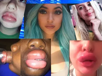 Не е за слаби нерви! Девойки се обезобразяват заради Кайли Дженър (Новата мания побърка нета)