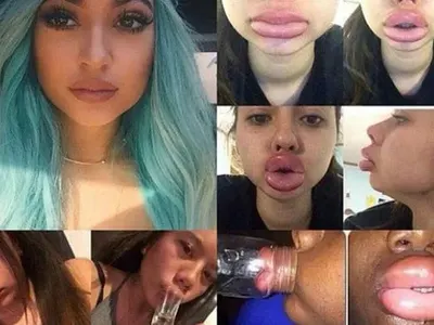 Не е за слаби нерви! Девойки се обезобразяват заради Кайли Дженър (Новата мания побърка нета)