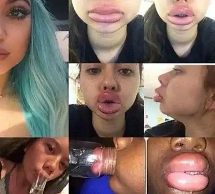 Не е за слаби нерви! Девойки се обезобразяват заради Кайли Дженър (Новата мания побърка нета)