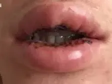 Брутално! Диджей се обезобрази с пластики! (Джуките му избухнаха, защото ги напомпал)