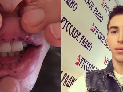 Брутално! Диджей се обезобрази с пластики! (Джуките му избухнаха, защото ги напомпал)