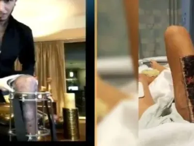 Оперират Джино за девети път (Брутални снимки от инвалидната количка)