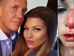 Пълен ОБРАТ! Гаджето на Сани Алекса: Не съм я пребил, тя падна по стълбите, сега ме изнудва за пари! (ВИЖТЕ разказа на шведа)