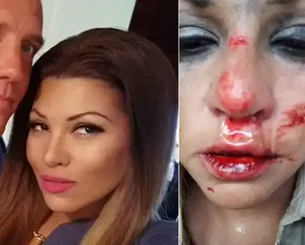 Пълен ОБРАТ! Гаджето на Сани Алекса: Не съм я пребил, тя падна по стълбите, сега ме изнудва за пари! (ВИЖТЕ разказа на шведа)