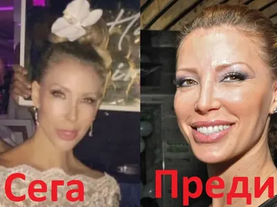Ирен Онтева остана без нос! Какво се е случило с моделката? (СНИМКИ преди и сега)