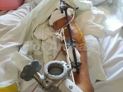 9-те живота на Джино: Брадърът е с 20 операции след побой и катастрофа! Хирурзи възстановявали главата му по снимка