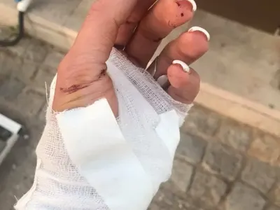 Хъски разкъса ръката на Мис Лято! Алина с опасност от ампутация заради гангрена (Снимка)