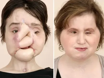 Това е най-младото момиче с присадено лице в света