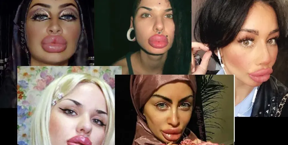 Вижте жените с най — грозните устни в света (ШОК СНИМКИ)