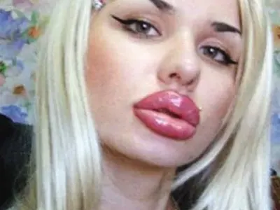 Вижте жените с най — грозните устни в света (ШОК СНИМКИ)