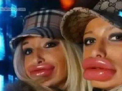 Вижте жените с най — грозните устни в света (ШОК СНИМКИ)