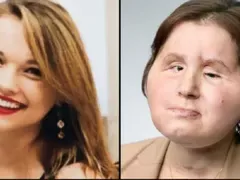 Това е най-младото момиче с присадено лице в света