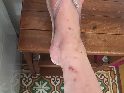 Бълхи нахапаха Мариела Нордел! Донесоха й инфекция, а лекарите се съмняваха, че е с тиф