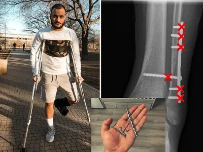 Лъчо от „СкандаУ” с 6 пирона в глезена, Луиза и Криско се пребиха с мотор, Кеца пее със счупени зъби, Азис с разбита глава...