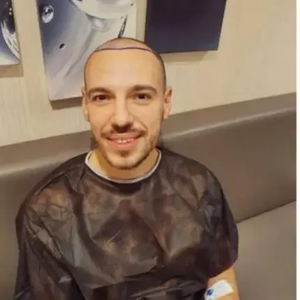 Дани Петканов си присади коса в Турция (Лудият репортер се бръкна само 1400 евро за процедурата)