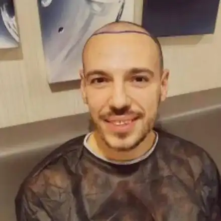 И присадената коса на Даниел Петканов окапа