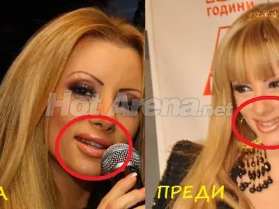 Ангелкова не е сама! Кои популярни личности са неузнаваеми след операции на носовете си ? (Уникални снимки)