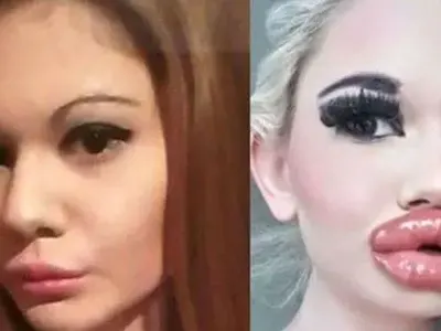 Родното Барби се подложи на 21-вата операция на джуките! Последиците може да са фатални (Подробности)