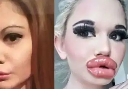 Родното Барби се подложи на 21-вата операция на джуките! Последиците може да са фатални (Подробности)