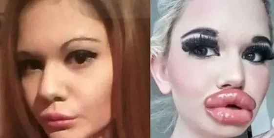 Родното Барби се подложи на 21-вата операция на джуките! Последиците може да са фатални (Подробности)