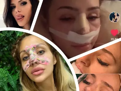 Резни ми носа да съм „красива“! По десет бона шарят ВИП персони за невинаги  успешни корекции