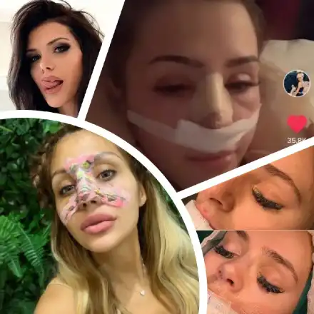 Резни ми носа да съм „красива“! По десет бона шарят ВИП персони за невинаги  успешни корекции