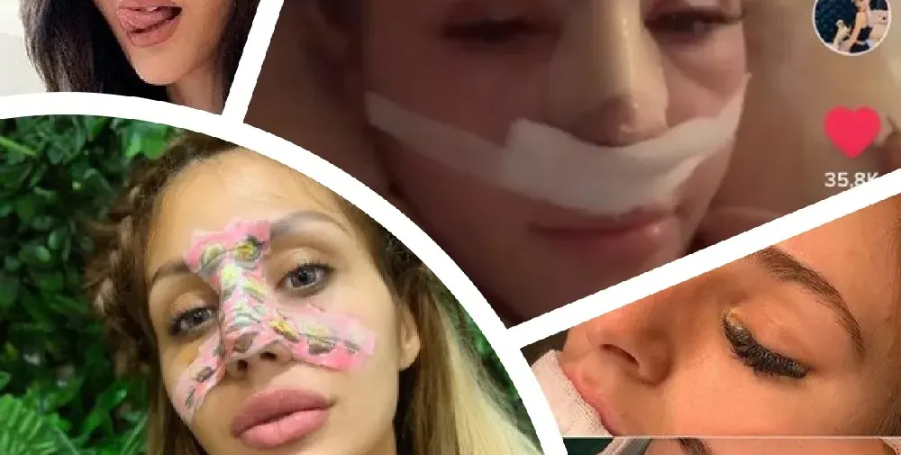 Резни ми носа да съм „красива“! По десет бона шарят ВИП персони за невинаги  успешни корекции