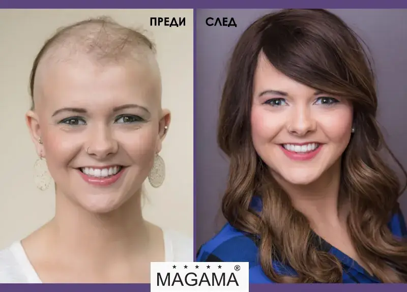 Решения за алопеция в салон Магама (Снимки)